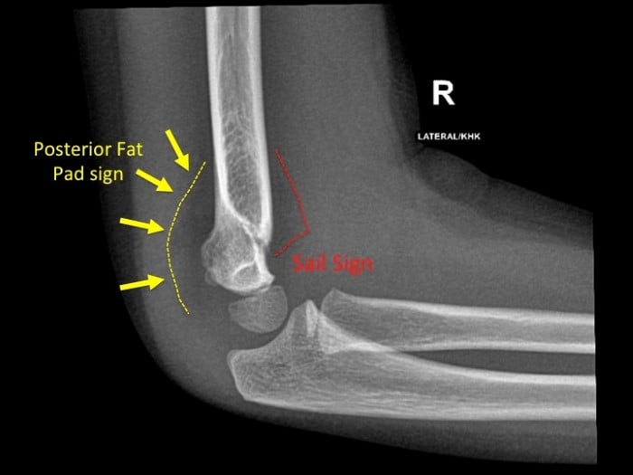 Fig 4.supracondylar-fracture-with-posterior-fat-pad-and-sail-signs.jpg