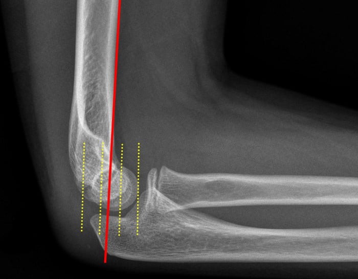 Fig 5.anterior-humeral-line.jpg