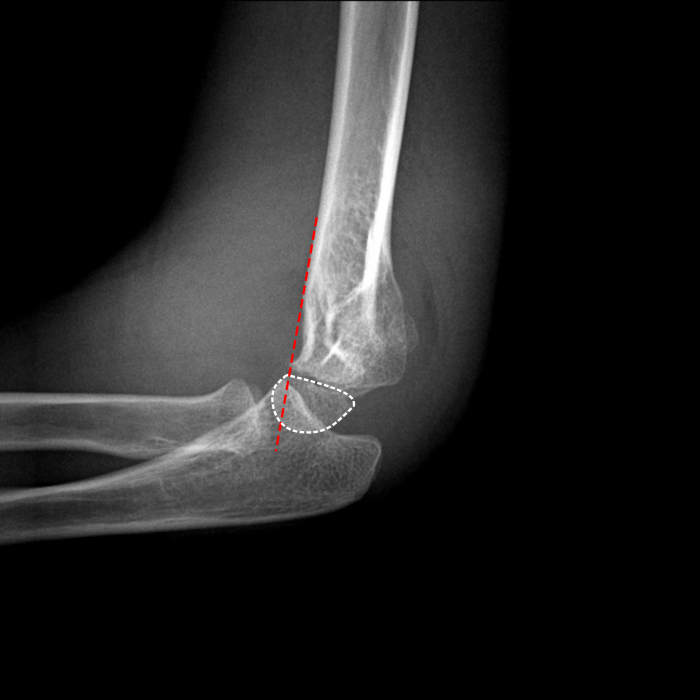 Fig 6.supracondylar-fracture-gartland-type-i.png