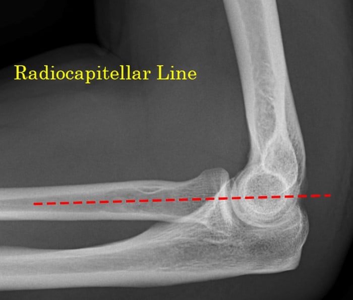Fig 7.radiocapitellar-line.jpeg