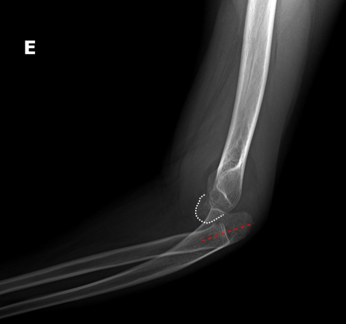 Fig 8.radial-head-dislocation-with-ulnar-bowing.png