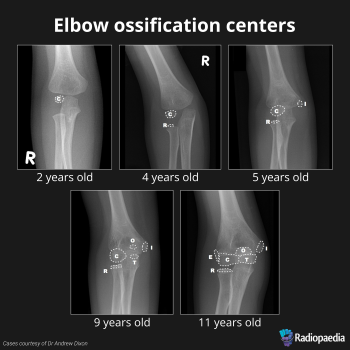 Fig 9.elbow-ossification-during-growth.png