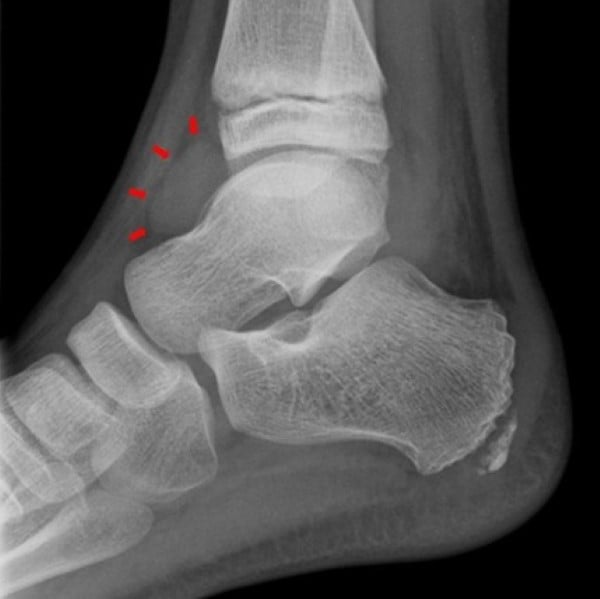 May 2026 Hemarthrosis - Figure.jpg