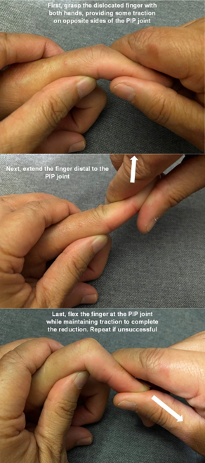 The Jammed Finger | SpringerLink