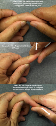 The Jammed Finger Sports Medicine Section