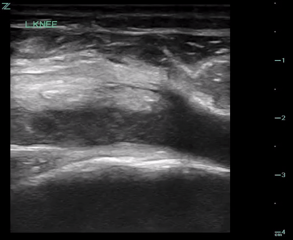 Evaluation of the subpatellar space.gif