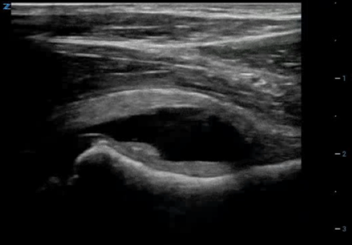 Hip to It Fig 1 POCUS demonstrating hip effusion.png