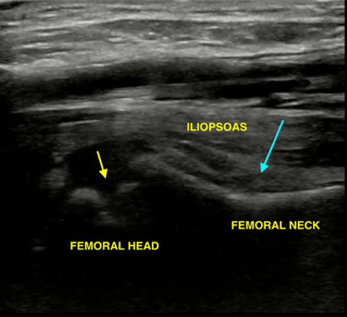 Hip to It Fig 2B - Normal Hip Anatomy.png