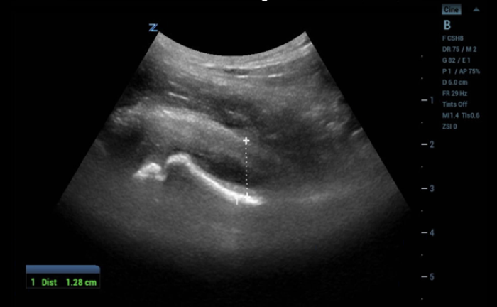 Hip to It Fig 3A - Hip effusion.png