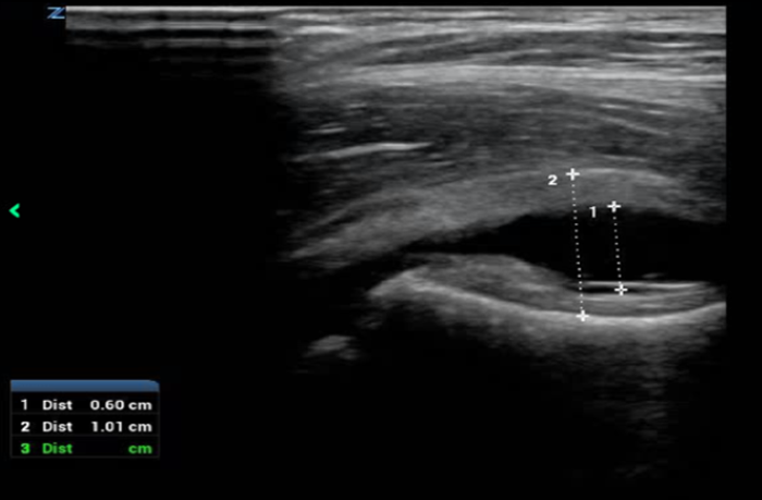 Hip to It Fig 3B - Hip effusion measurements.png