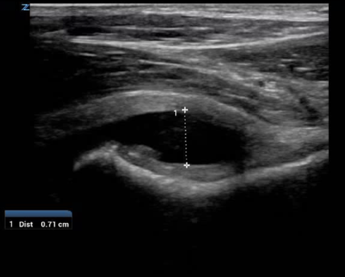 Hip to It Fig 5 - Hypoechoic hip effusion.png