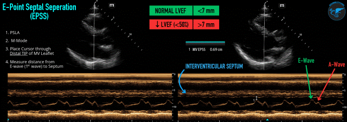 LVSF_Figure 1_EPSS v3.gif