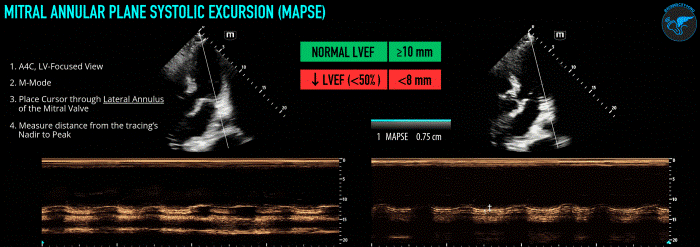 LVSF_Figure 2_MAPSE 3.gif