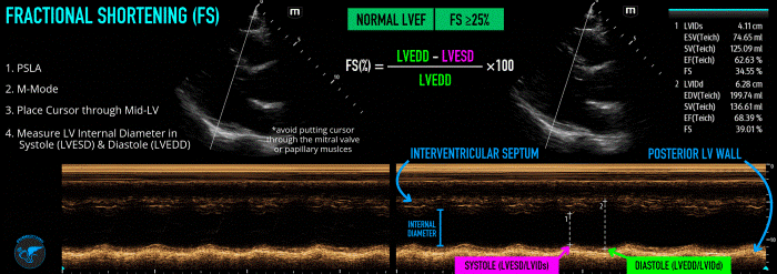 LVSF_Figure 3_Fractional Shortening v3.gif