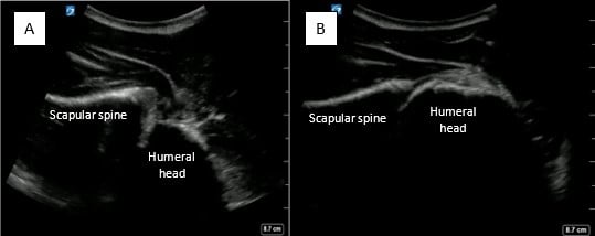 May2025-Pedi Interscalene_Fig 1.jpg