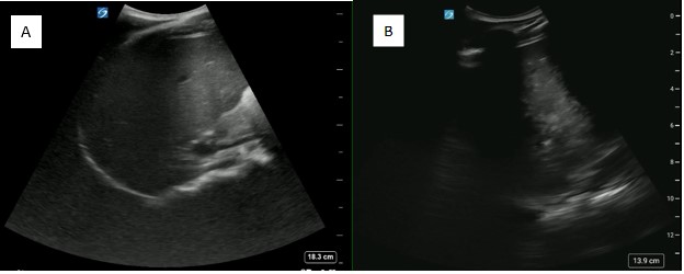 May2025-Pedi Interscalene_Fig 4.jpg