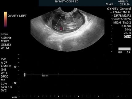 ovarian-fig-2.jpg