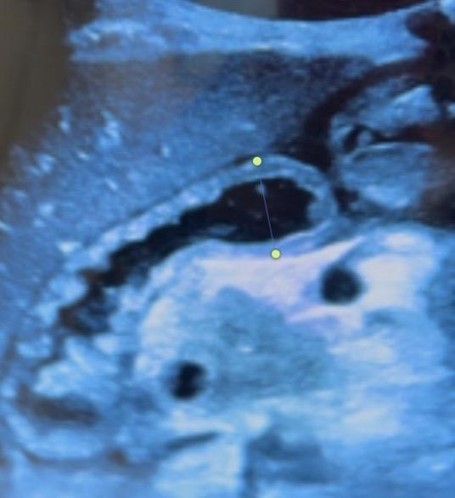 POCUS before CT 1.jpg