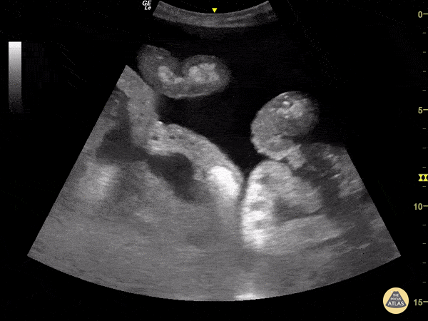 Transforming Ascites.gif