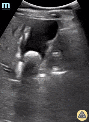 Transforming Cholelithiasis.gif