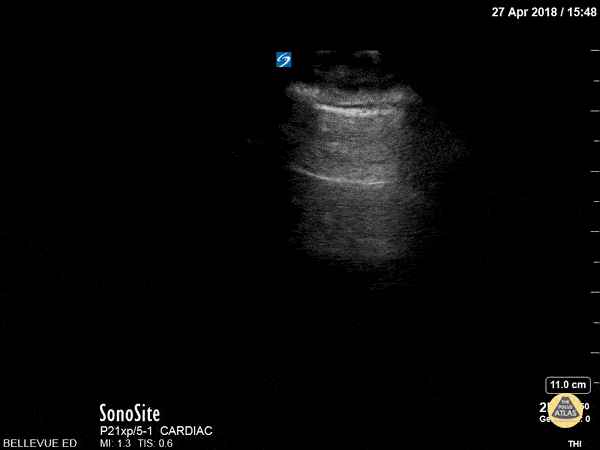 Transforming LungSliding A-lines.gif