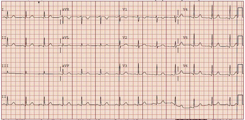 EKG1.jpg