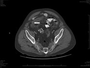 Ruptured Appendix Ultrasound