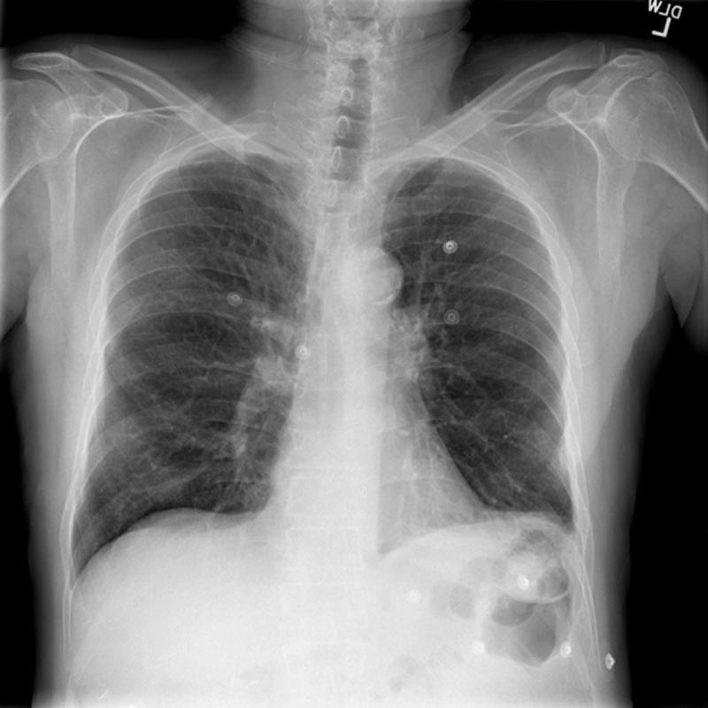 COPD CXR - hyperinflated only.jpg