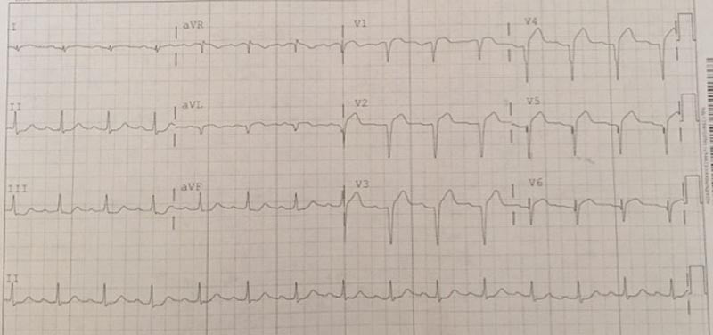 EKG-ANT-MI.jpg