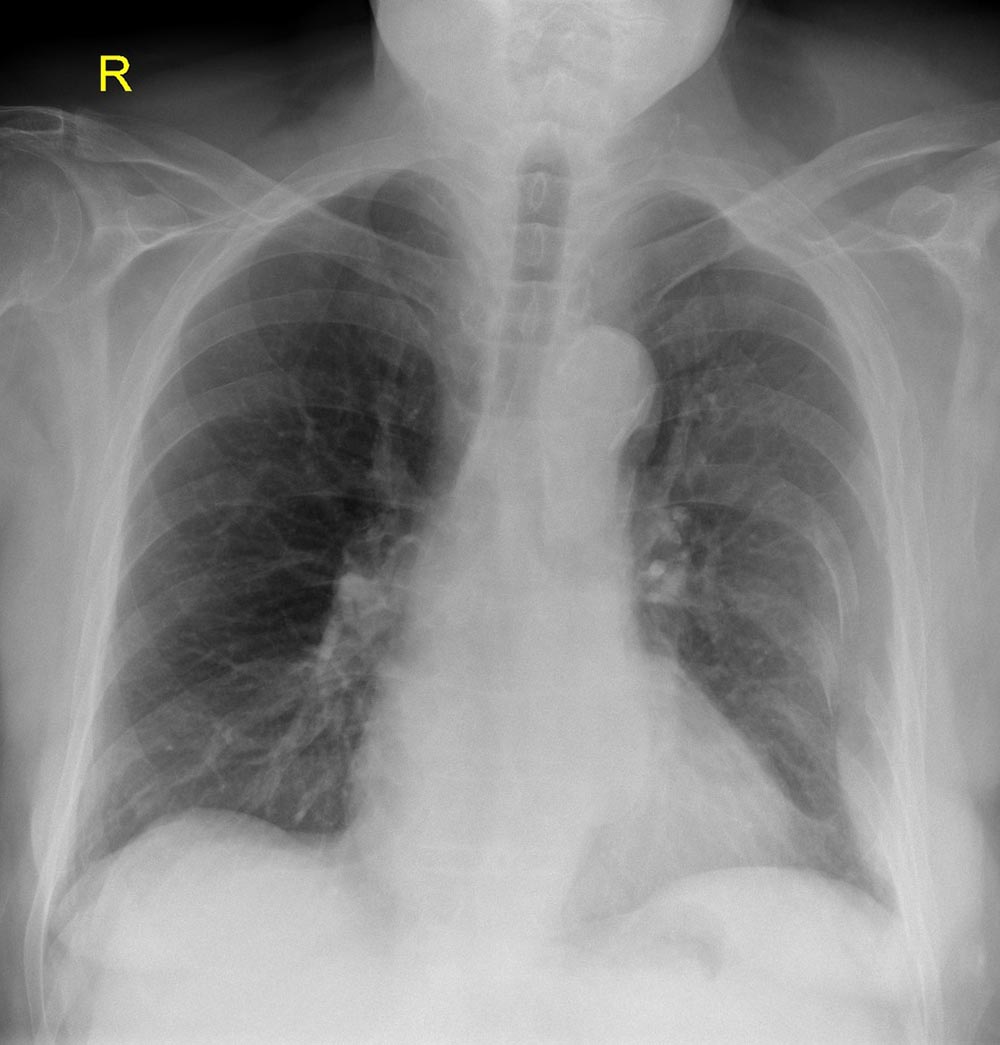 CXR left-sided-rib-fractures.png