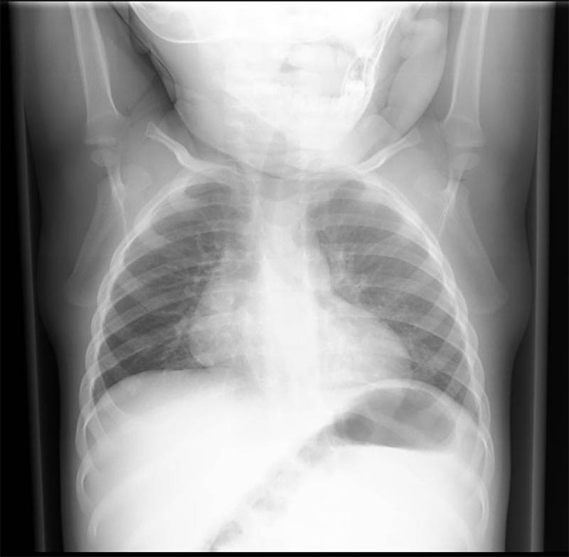 CXR.jpg