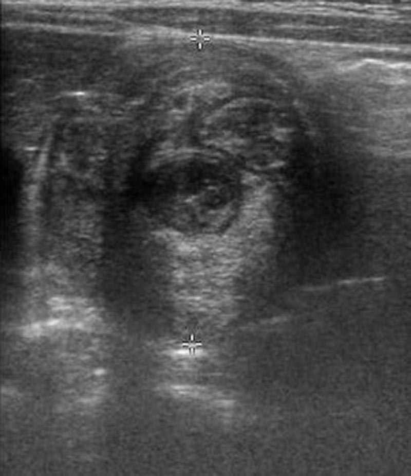 Intussuception Peds-1.jpg