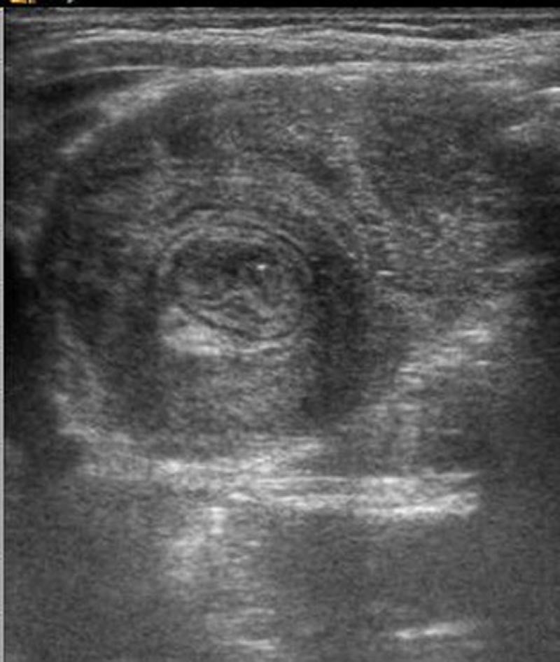 Intussuception Peds-2.jpg