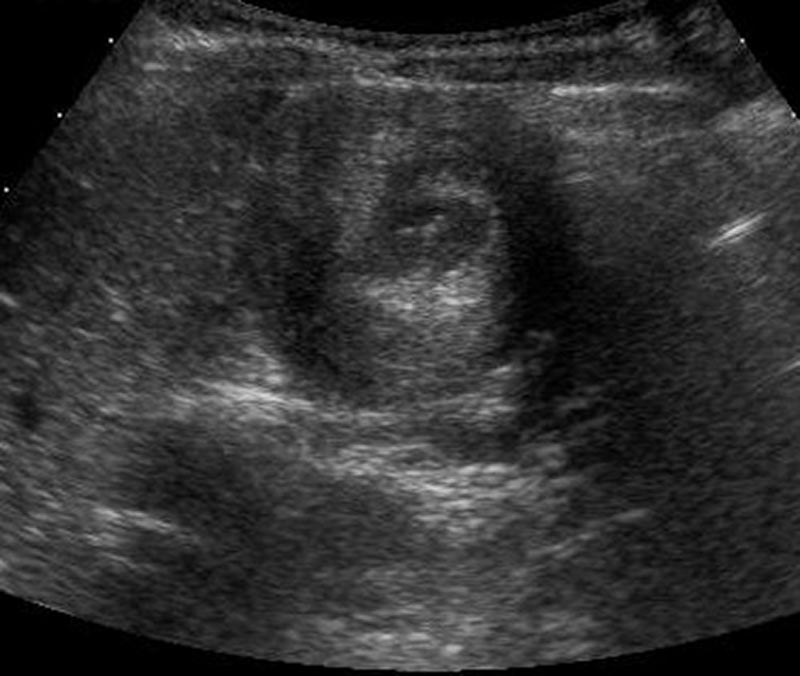 Intussuception Peds-3.jpg