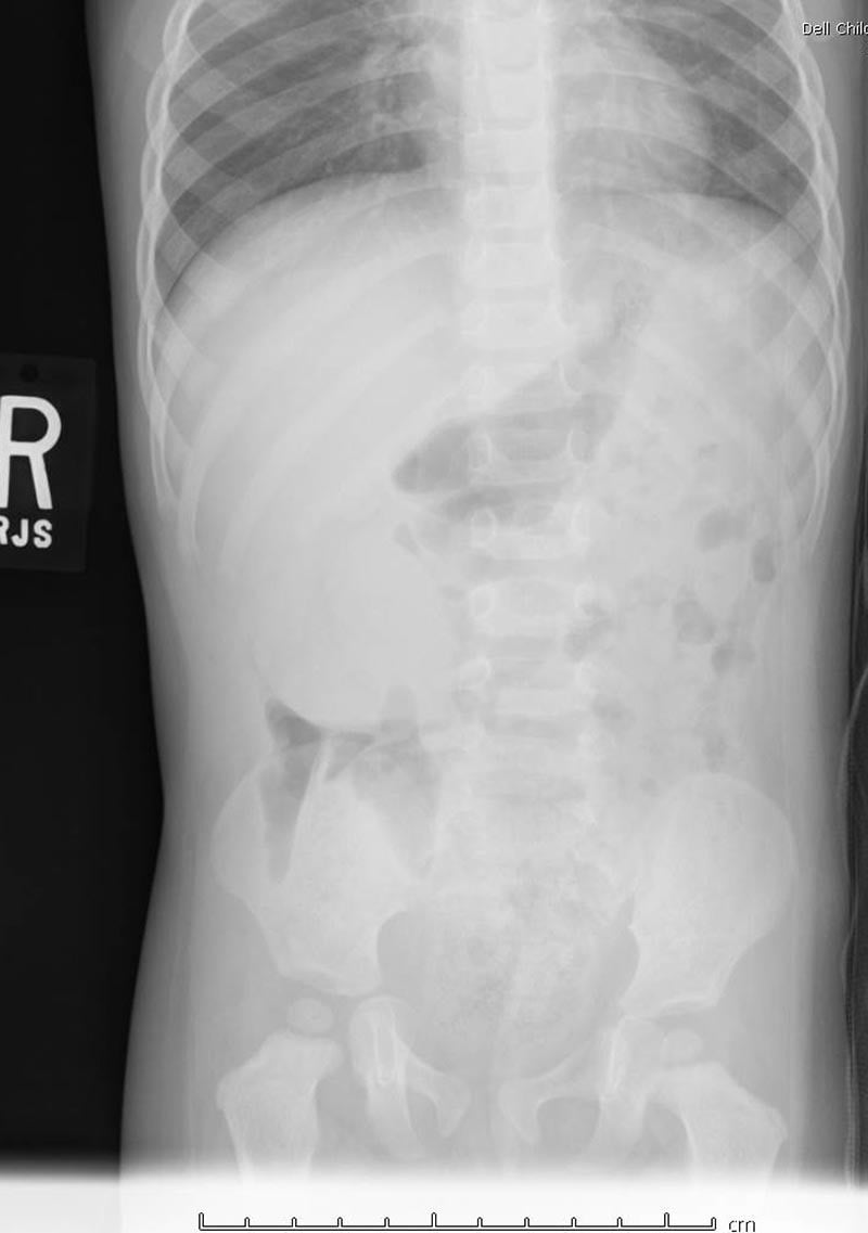Intussuception Peds-5.jpg
