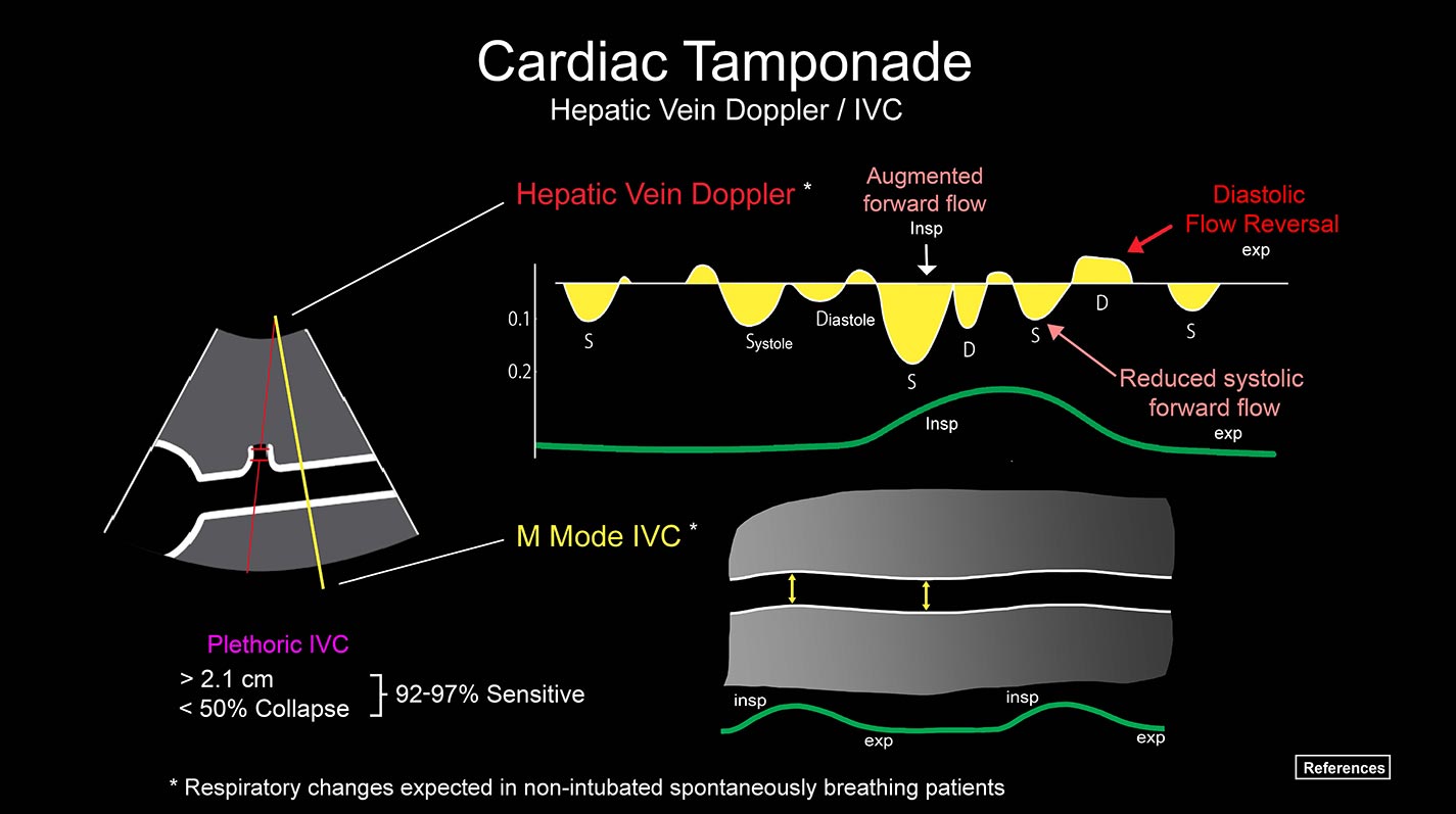 CardiacTamponadeHepaticVein1425.jpg