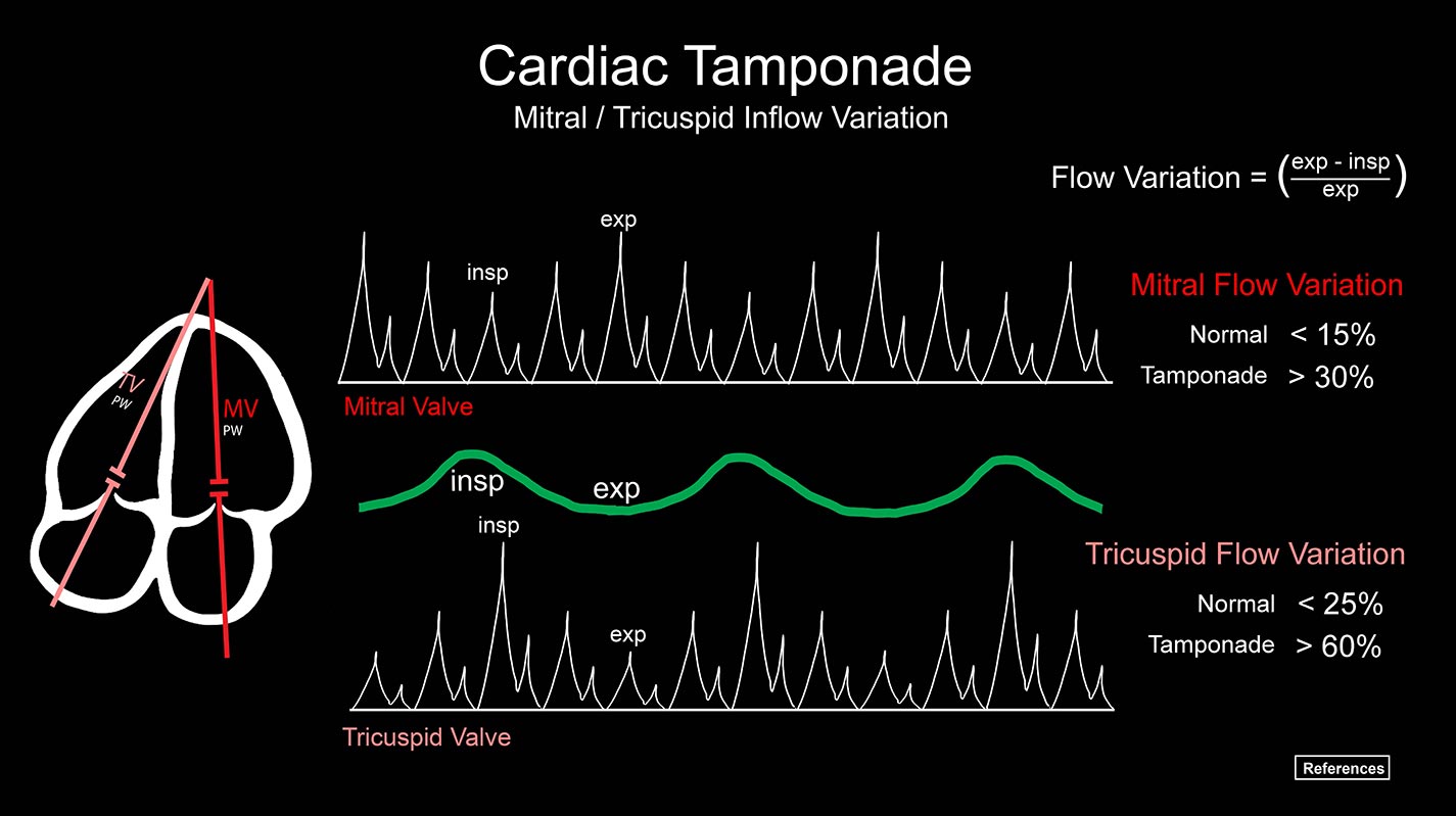 CardiacTamponadeInflow1425.jpg